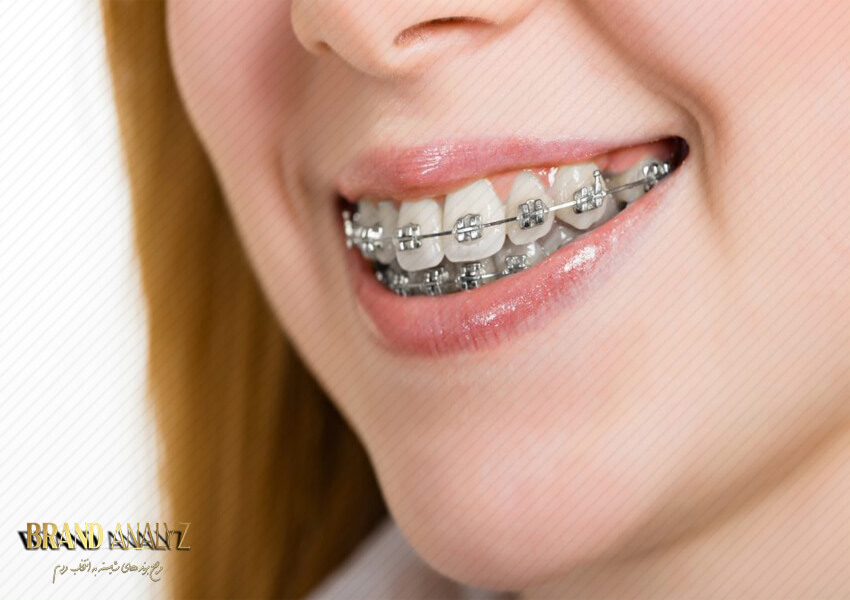 10 نکته اساسی که باید قبل و بعد از ارتودنسی دندان بدانید