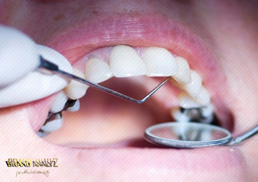 آمالگام دندان برای پر کردن بهتر است یا کامپوزیت؟