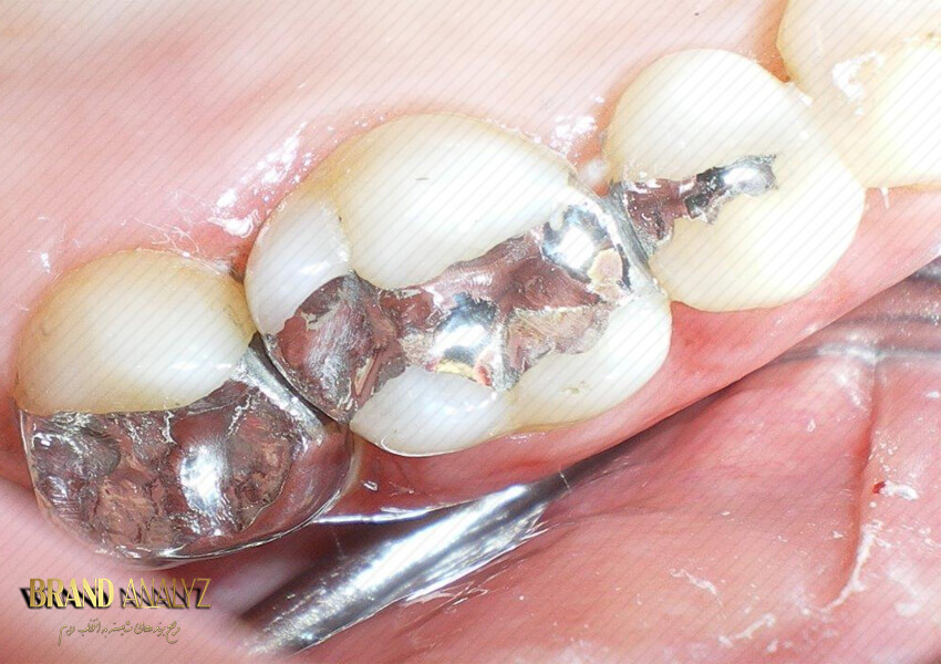 آمالگام دندان چیست؟