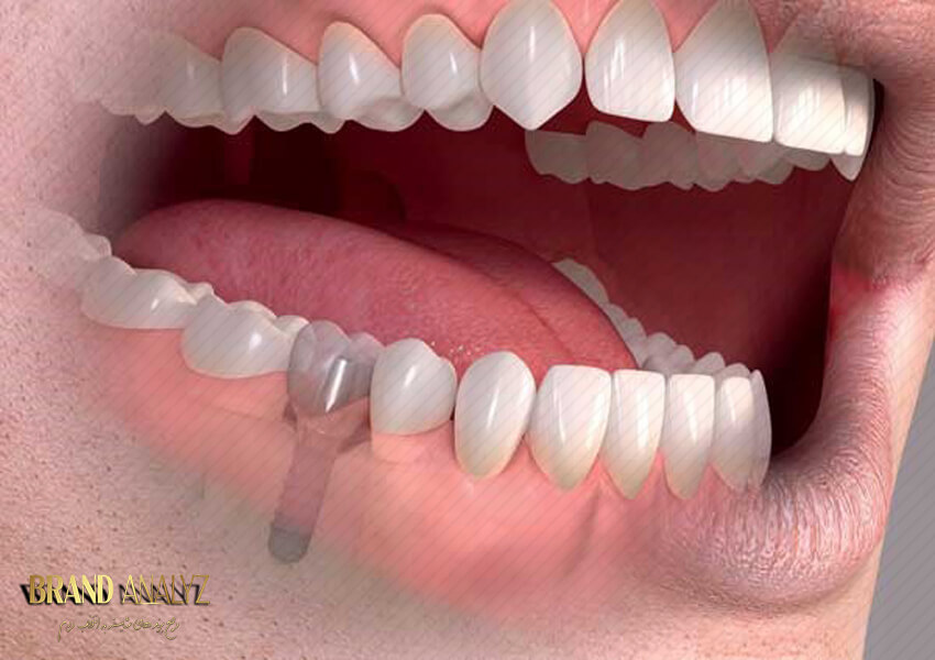 انواع ایمپلنت دندان و روش انجام آن